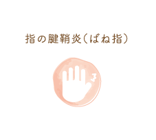 指の腱鞘炎（ばね指）
